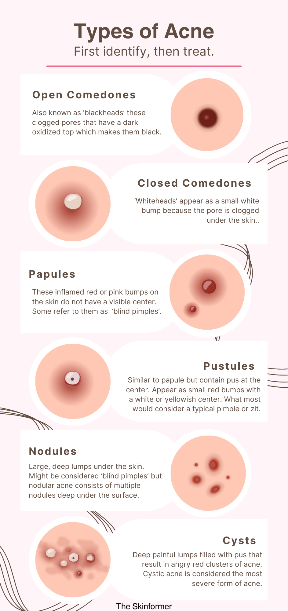 Types of acne and characteristics