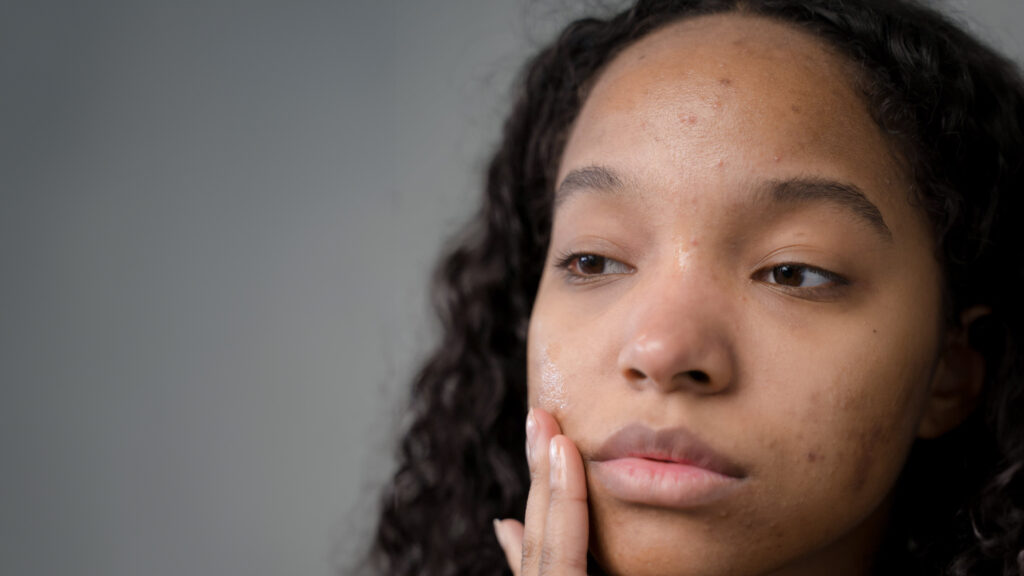 Woman examines acne with solemn expression