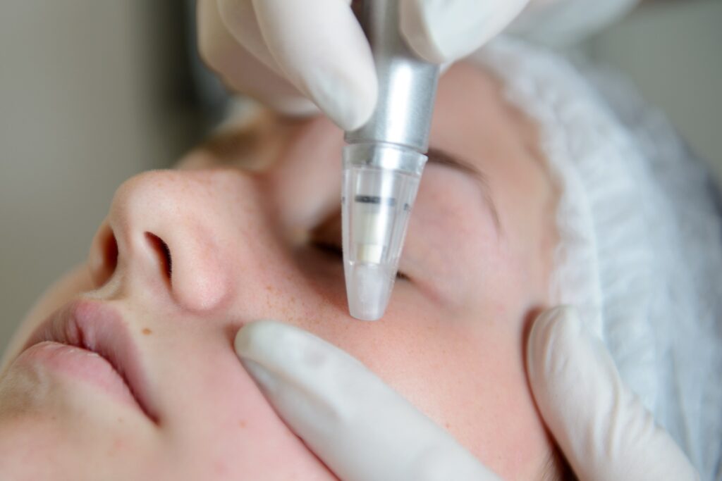 woman receiving microdermabrasion treatment on face in a salon or spa