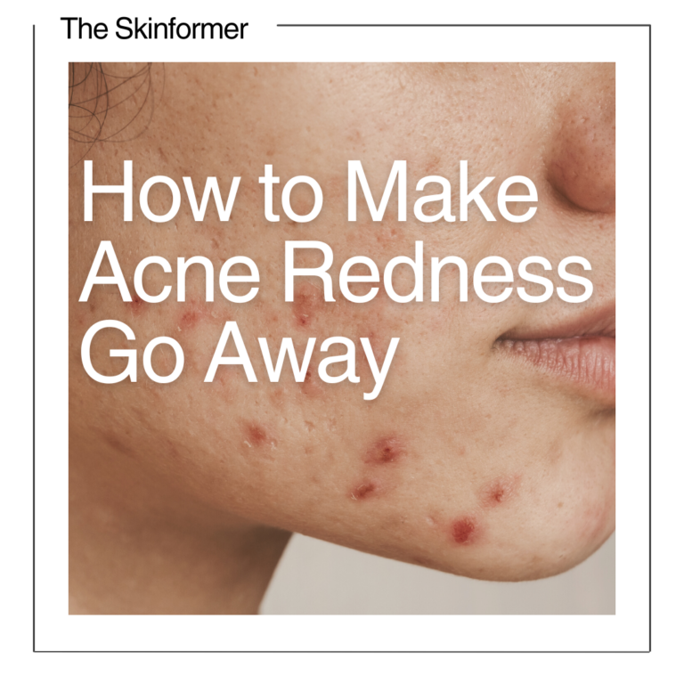 Close up of acne redness with text overlay which reads 'How to Make Acne Redness Go Away'